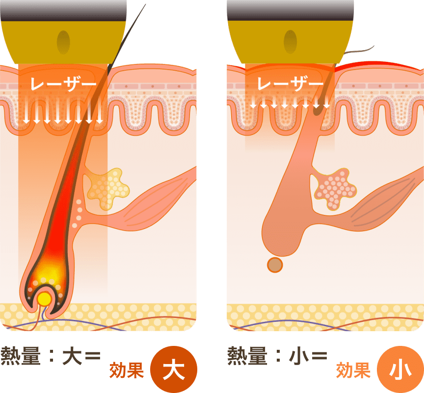 レーザー熱量による効果の大小