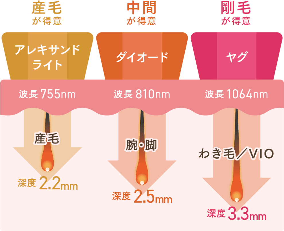 医療脱毛で用いられる３種類のレーザー